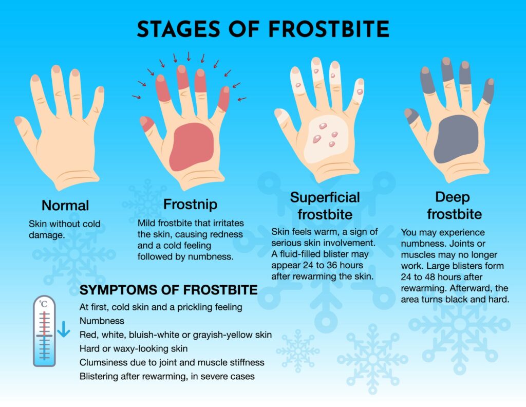 Understanding Frostbite The Dangers Signs Treatments And Prevention Tactics Breaking Weather