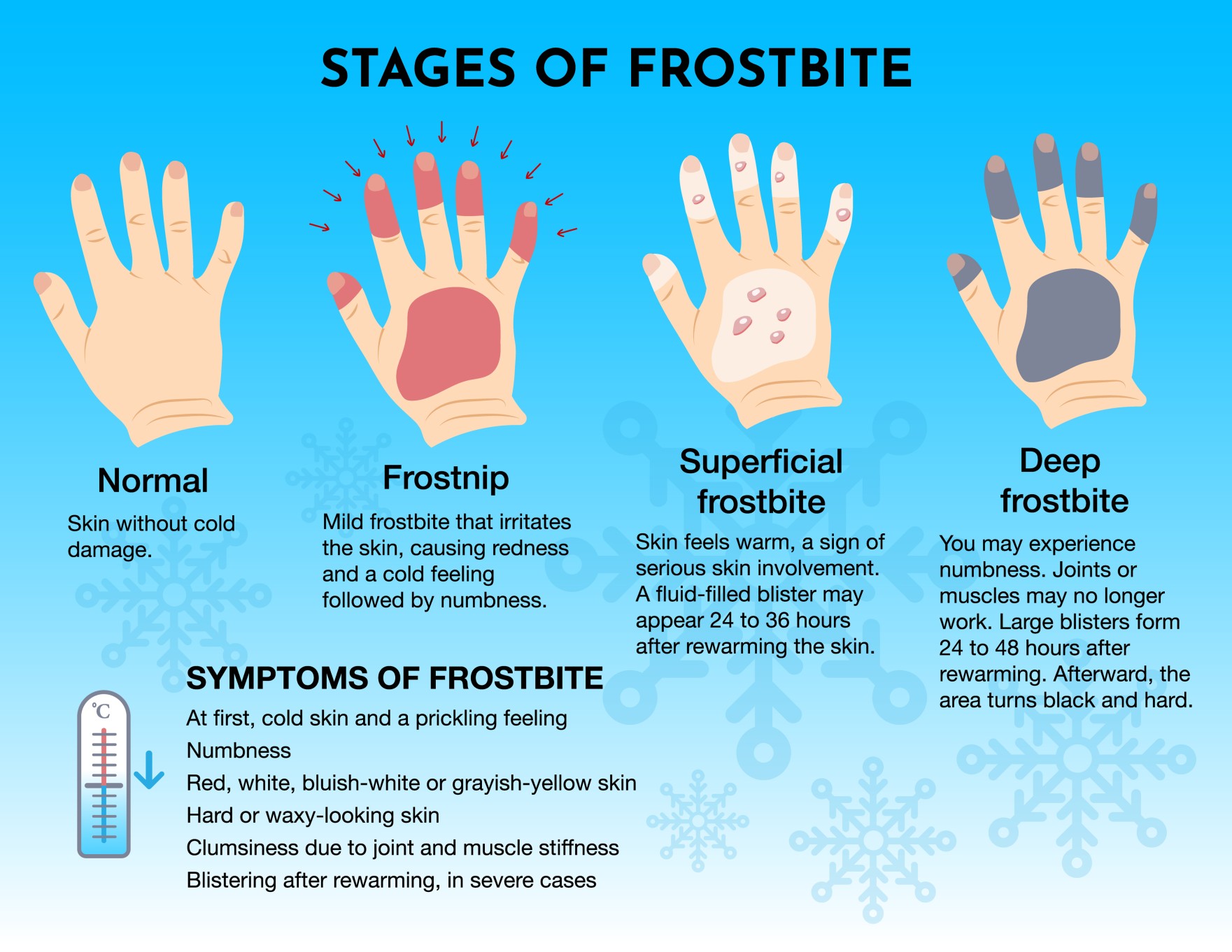 Understanding Frostbite: The Dangers, Signs, Treatments, And Prevention 